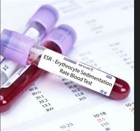 Esr Blood Test Services at best price in Ahmedabad | ID: 19255639191