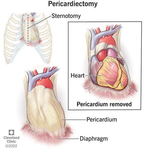 Pericardial Effusion: Symptoms, Causes And Treatment, 42% OFF