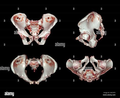 CT scan of Pelvic bone and hip joint 3D rendering for diagnosis fracture of Pelvic bone and hip ...