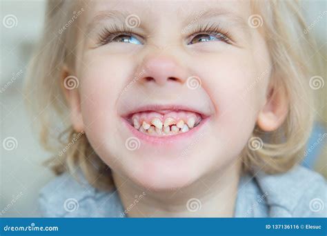 Boy. Bad teeth. stock photo. Image of cavity, healthy - 137136116