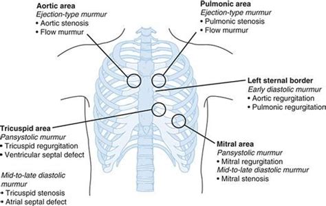 Image result for aortic area murmur | Medis