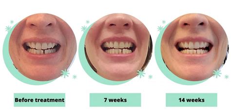 Byte Teeth Aligners Impression Kit Reviews - Is Byte Teeth Legit or Scam?