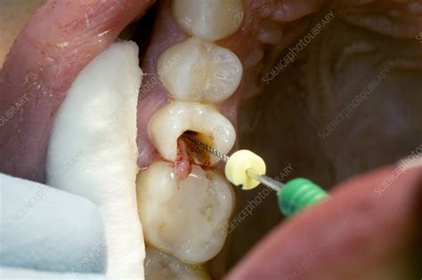 Root canal dental surgery - Stock Image C029/0466 - Science Photo Library