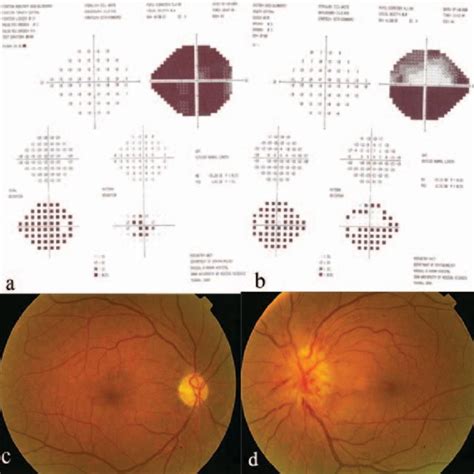 Nonarteritic anterior ischemic optic neuropathy (NAION) in the left eye ...