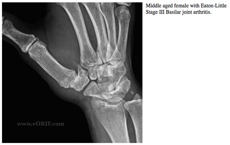 Icd 10 Code For Cmc Joint Arthritis