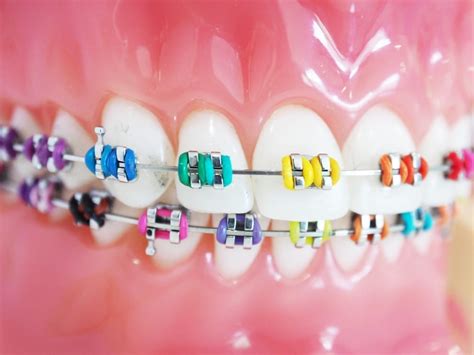 How to Select the Right Braces Colors - Orthodontic Arts