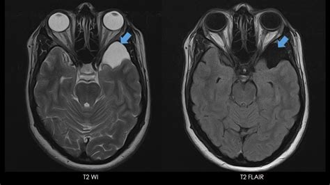 Posterior Fossa Arachnoid Cyst Mri