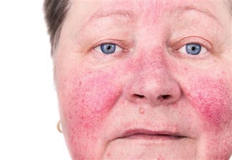 Rosacea What Is It What Causes It And How To Tell If You Have It | SexiezPicz Web Porn