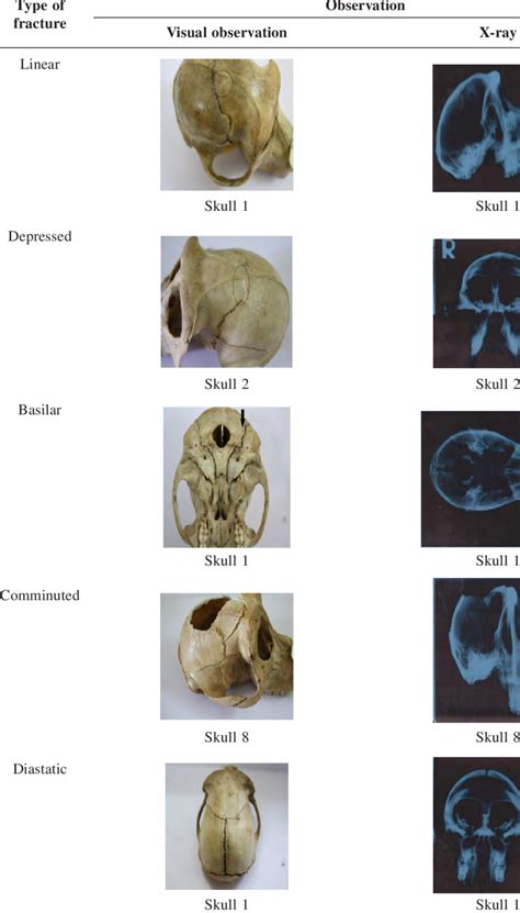 Types of skull fractures encountered | Download Table