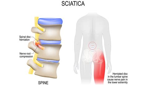 Herniated Disc Treatment