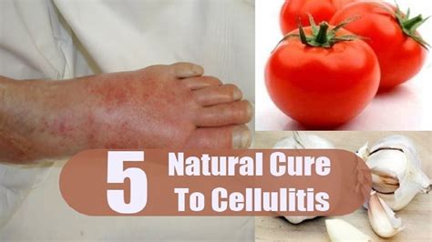 Cellulitis Treatment