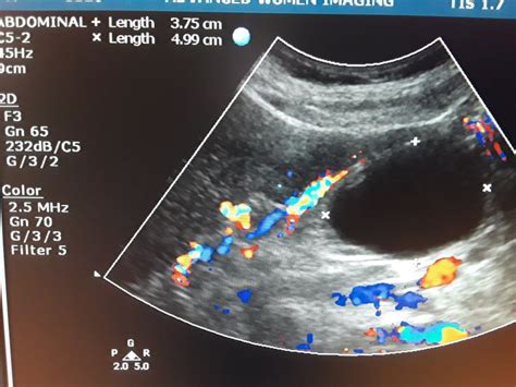 Simple Renal Cyst | Renal, Cysts, Ultrasound