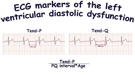 ECG markers of the left ventricular diastolic dysfunction: Tend-P, Tend-Q - YouTube