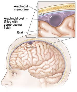 Arachnoid Cyst (Leptomeningeal Cyst) | Saint Luke's Health System