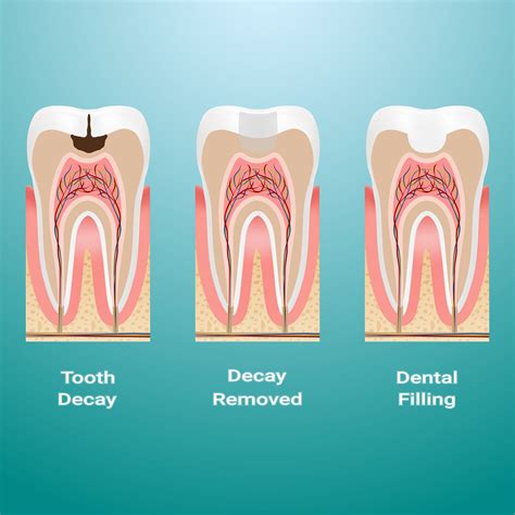 How Do Fillings Work?