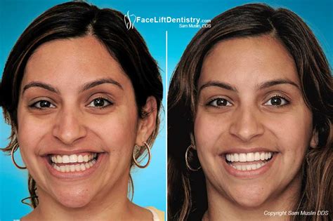 Replacing Bad Porcelain Veneers