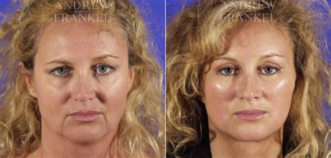 Midface Lift before and after photos - Andrew S. Frankel, MD