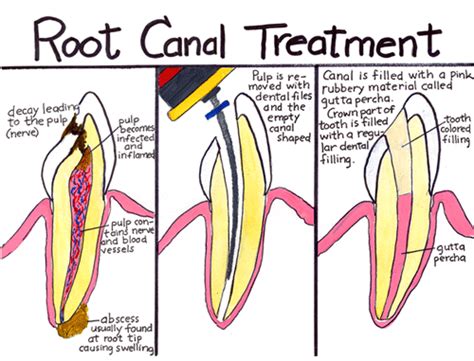 STEPS IN ROOT CANAL TREATMENT | DENTALORG.COM