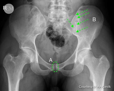 Pelvic X-ray interpretation – International Emergency Medicine Education Project