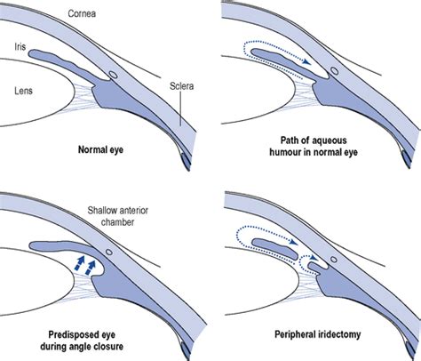 Narrow Angle Glaucoma - Fraser Eye Care Center