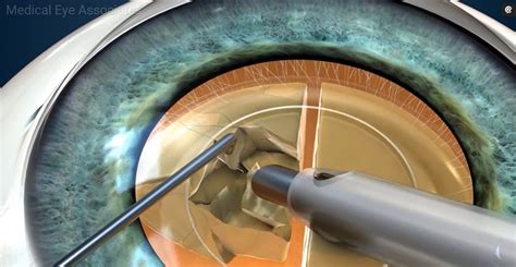 Cataract Surgery at Medical Eye Associates - Medical Eye Associates