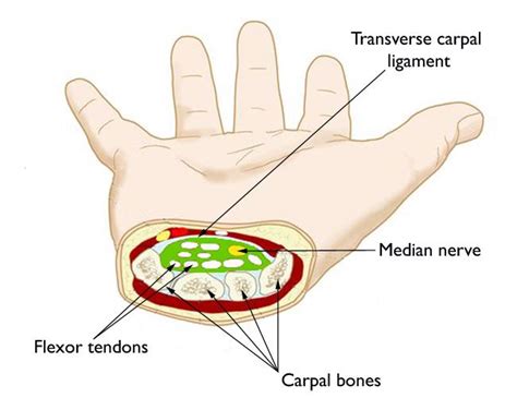 Carpal Tunnel Syndrome - Mendelson Kornblum