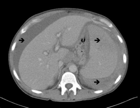 Lymphoplasmacytic lymphoma CT scan - wikidoc