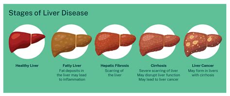 Cirrhosis - Liver Foundation