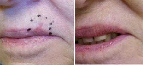 Photos Of Melanoma On Lips | Lipstutorial.org