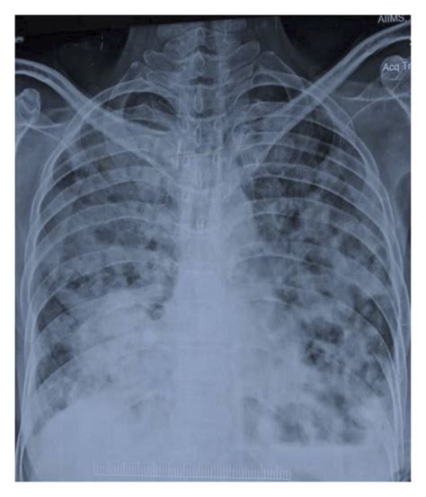 X-ray chest PA view shows bilateral diffuse consolidation and cavitation. | Download Scientific ...