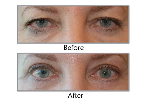 Botox For Saggy Eyelids | eyesclinic