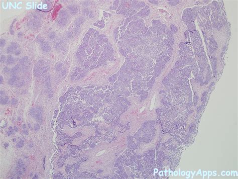 wilms tumor pathology