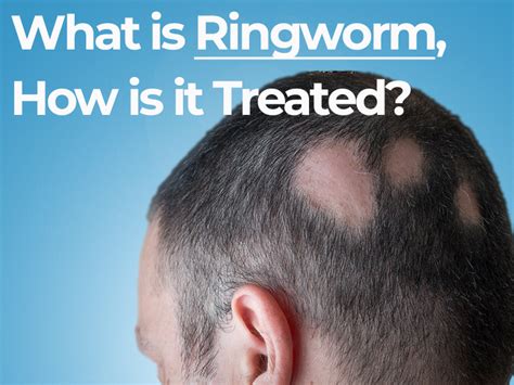 What is Ringworm, How is it Treated? - Quartz Hair