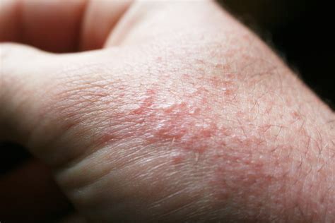 5 Common Summer Rashes and How to Prevent Them | Hartford HealthCare | CT