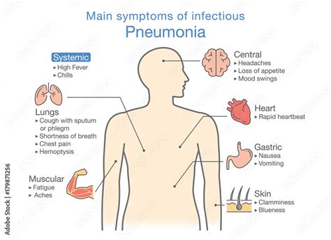 Main symptoms of infectious Pneumonia. Illustration about diagram for health check up. Stock ...