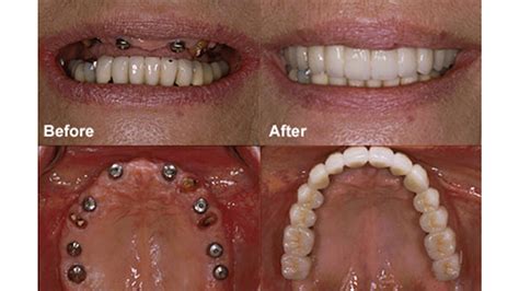 dental-implants Before and after | Dr. Ari Greenspan Dentist