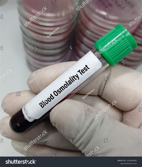 Blood Sample Serum Osmolality Test Helps Stock Photo 2224600805 | Shutterstock