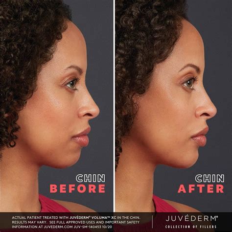 Voluma™ is now FDA-approved for chin augmentation