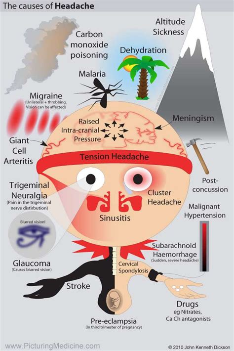 Headache and Facial Pain - Differential Diagnosis, Examination and ...