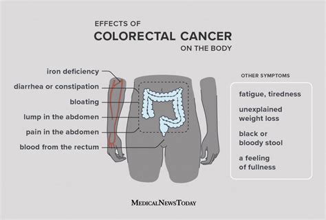 Colorectal Cancer Symptoms