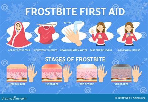 Frostbite Infographics. Symptoms, Protection And First Aid. Medical Frostbite Stage. Hypothermia ...