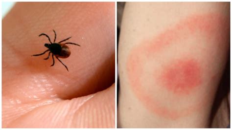 What to do when you're bitten by a tick: 7 steps | CBC News