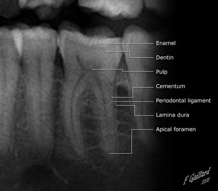 Radicular Cyst Radiology