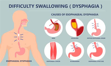 The Causes Of Esophageal Dysphagia In 2020 Dysphagia Dysphagia | Images and Photos finder