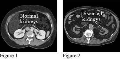 CT KUB Scan: Price, Purpose, Procedure, & Contrast [2024]