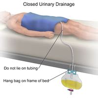 A Caregiver's Guide to: Urinary Catheter | Jaga Me