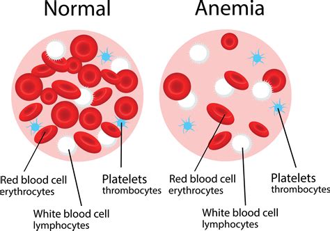 Anemia: Causes, Symptoms, Diagnosis, Treatments