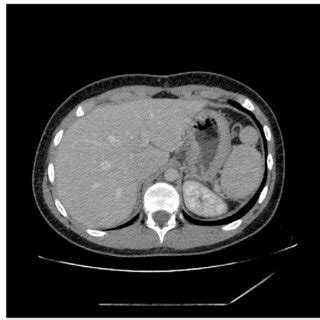 The small accessory spleen fixed in the native spleen position | Download Scientific Diagram