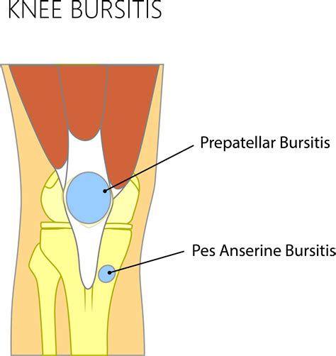 Knee Bursitis — Adam B. Cohen, MD