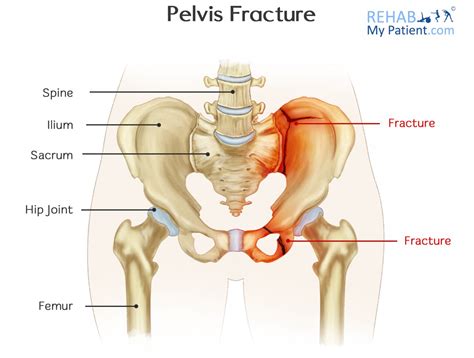 Pelvis Fracture | Rehab My Patient